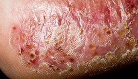 Dermatomykóza