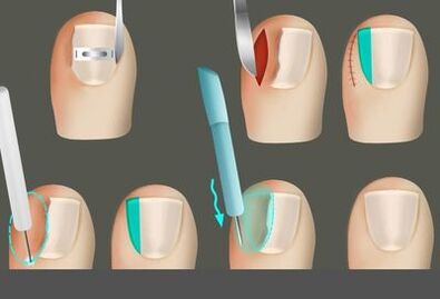 Odstránenie nechtu v prítomnosti huby na nohách
