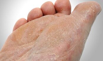 Cesty prenosu húb chodidla