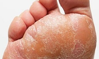 Príznaky a príznaky húb na nohách