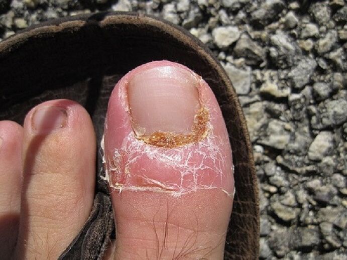 poškodenie nechtov a kože prstov v dôsledku plesňovej infekcie